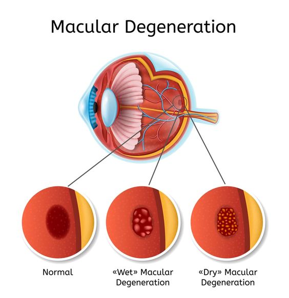 Macular Degeneration: Symptoms, Diagnosis and Treatment